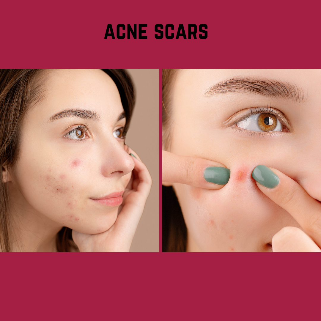 How to remove acne scars naturally